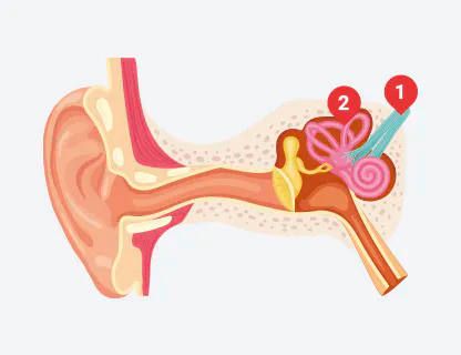 Pérdida Auditiva Neurosensorial