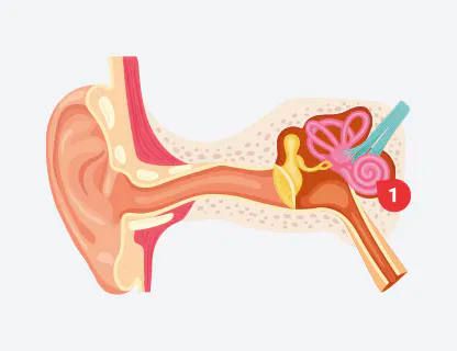 Pérdida Auditiva Mixta